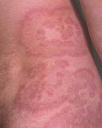 кільцеподібна еритема